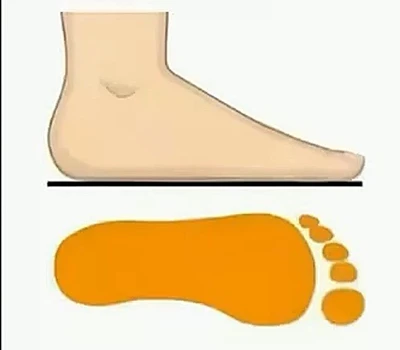 The Professional's Guide to Flat Feet Assessment: Why Proper Evaluation Matters
