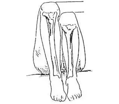 Leg Length Discrepancy (LLD) Assessment: A Practical Guide for Health, Performance, and Business ...