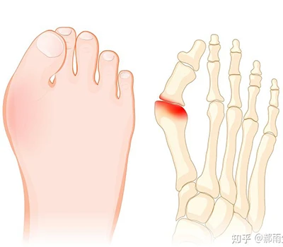 Hallux Valgus: Ένας πλήρης επιστημονικός οδηγός