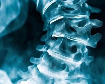 AI Scoliosis Screening and Spinal Alignment Tracking: Μια πιο έξυπνη τρισδιάστατη λύση προσυμπτωμ...