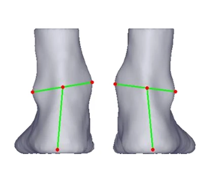 Heel Valgus και Varus: Μια σιωπηλή απειλή