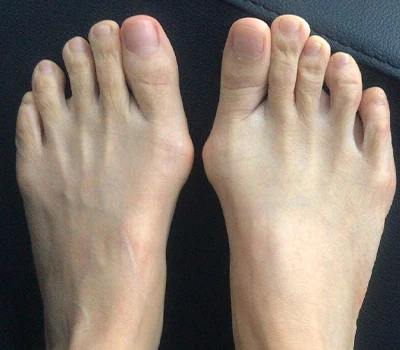 Η μέτρηση του Hallux Valgus: Γιατί οι 3D σαρωτές ξεπερνούν τους κλινικούς και τα νοσοκομεία
