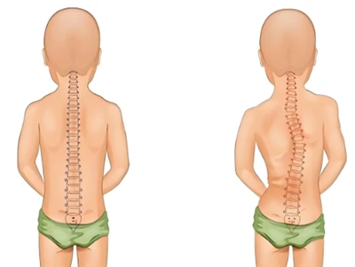 Νέα μέθοδος ελέγχου σκολίωσης: AI & 3D Digital Spine