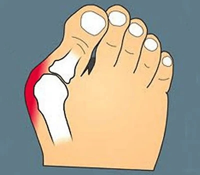 Transforming Bunion Care: Ενσωμάτωση σάρωσης ακριβείας για βελτιωμένη προσαρμογή, αφοσίωση ασθενώ...